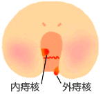 いぼ痔の図